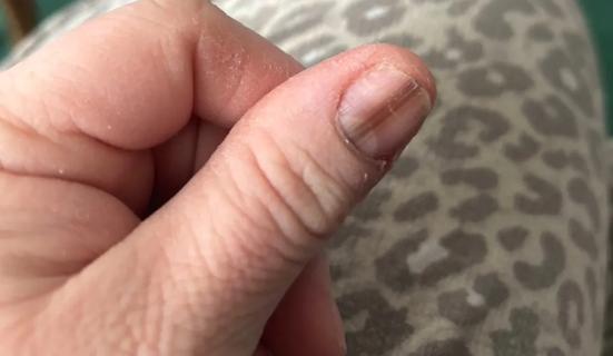 Lauren Koltcz shows a dark line on her thumb nail.
